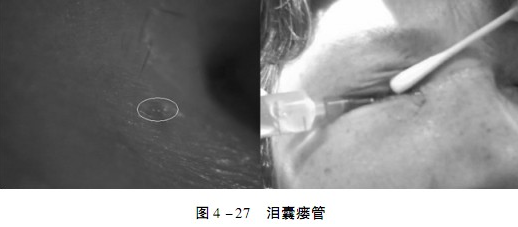瘘管从泪囊直接开口于鼻腔者称内侧瘘,患者无自觉症状,临床不易发现